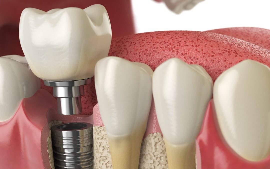 Implantes